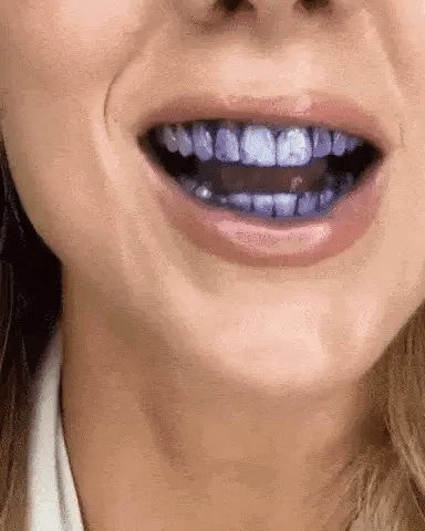 IvorySmile® Clip-On Bundle | 3 + 1 Free Toothpaste