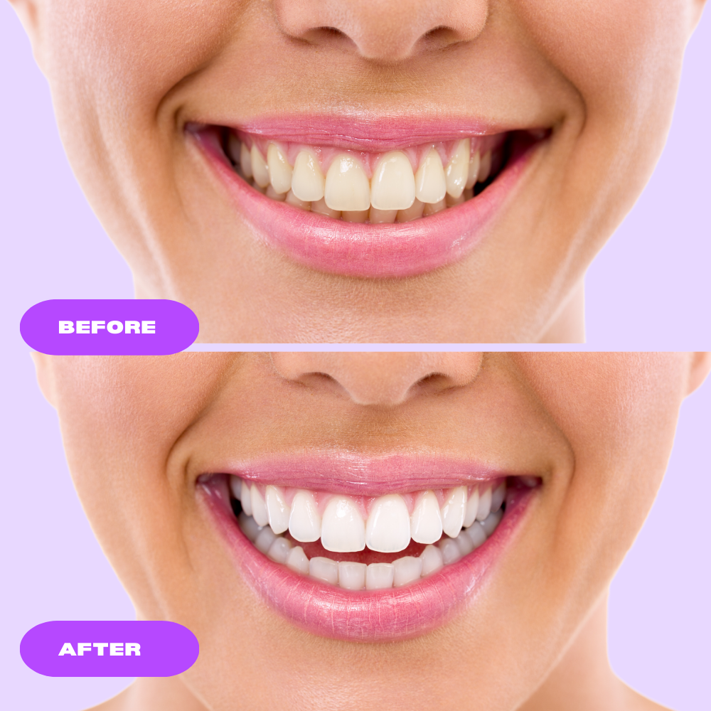 IvorySmile Teeth Whitening Therapy