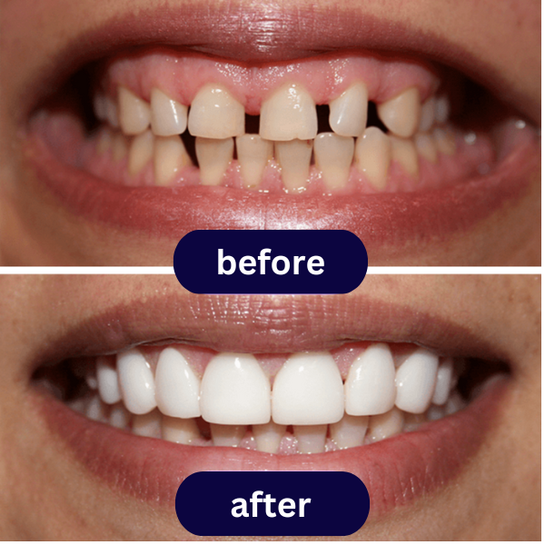 Disposable Instant Smile