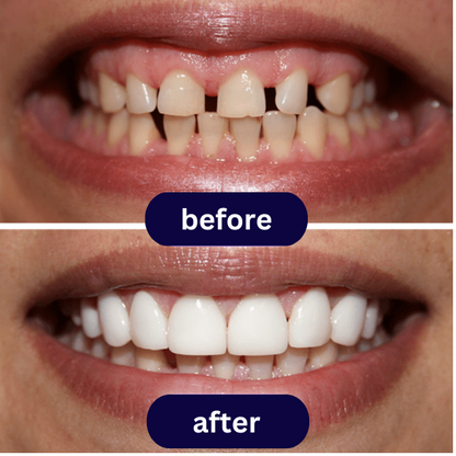 Disposable Instant Smile