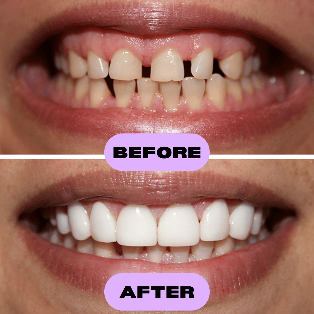 IvorySmile® Clip-On Bundle | 2 + 1 Free